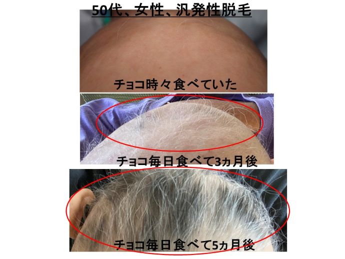 円形脱毛症　病院